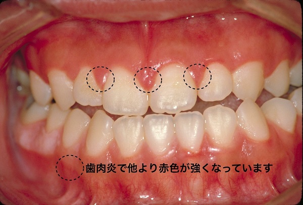 写真1：歯肉炎の歯茎と顎の骨