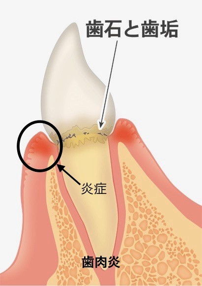 図2：歯肉炎