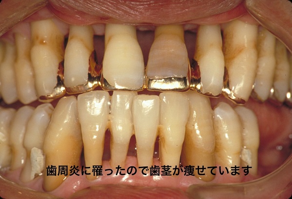 写真2：歯周炎の歯茎と顎の骨