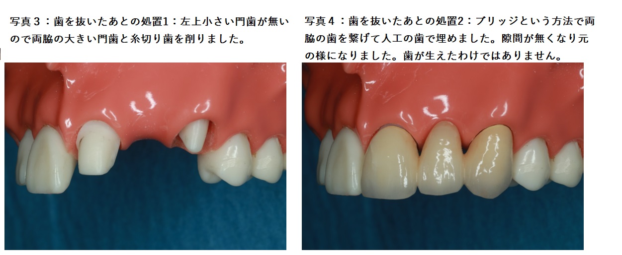 写真3：歯を抜いたあとの処置1 写真4：歯を抜いた後の処置2